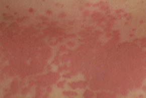 Alergija na sunce