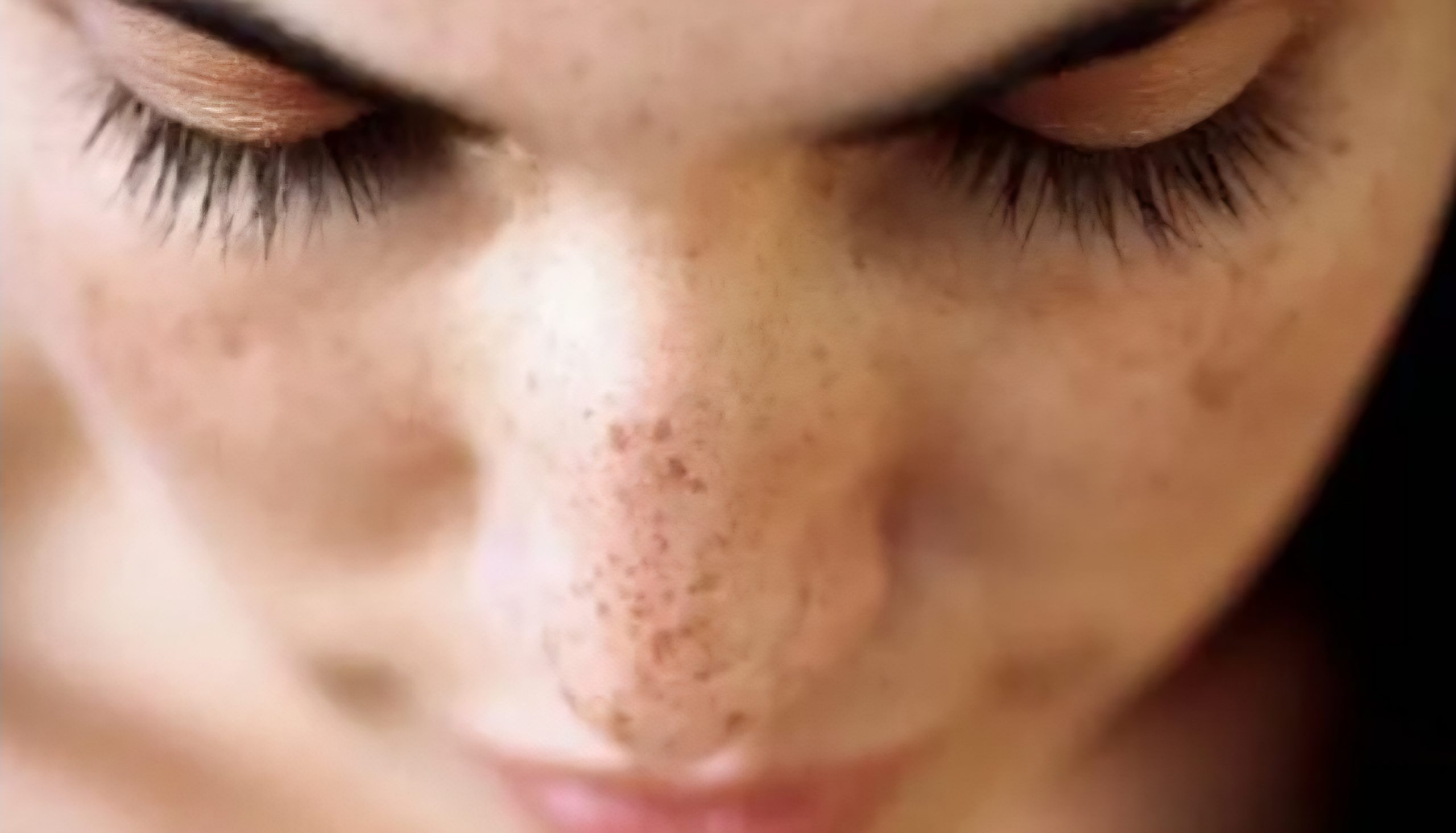 Staračke pjege: što su i kako ih se riješiti?